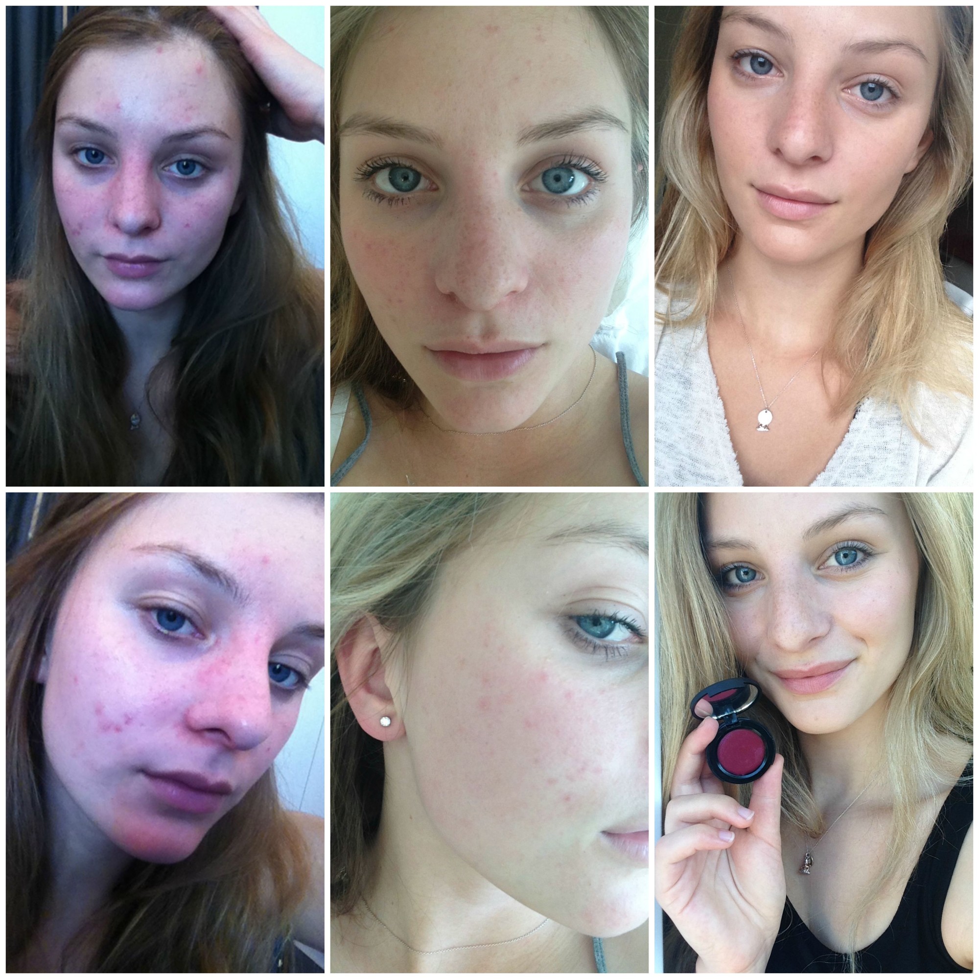 How I Cured my Cystic Acne & Rosacea